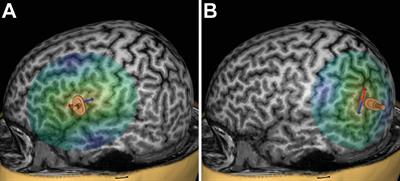 Investigating Stimulation Protocols for Language Mapping by Repetitive Navigated Transcranial Magnetic Stimulation